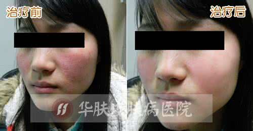 治疗皮肤病的偏方 皮肤偏方 皮肤病的原因