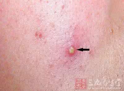 毛囊炎中医方剂 外科方剂 毛囊炎中药方剂