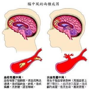 脑栓塞和脑血栓的区别 【转载】脑出血、脑血栓和脑栓塞的区分