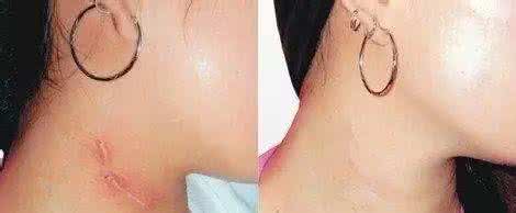 祛疤疤痕 怎样去疤痕 祛疤得看看这3种方法