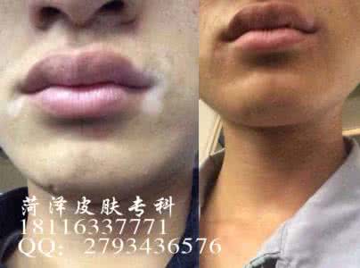 眼睑神经性皮炎治疗 【祖传秘方】治疗眼睑皮肤癌神方，无一例复发，不留瘢痕