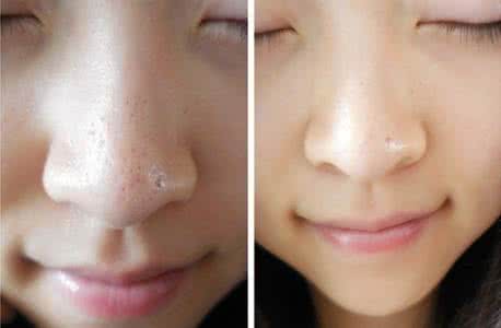 去黑头的最好方法牙膏 用牙膏可以去黑头吗？牙膏去黑头的方法