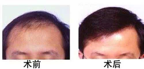 还在脱落中植发有用吗 还在脱落中植发有用吗 艾烟这么有用,你却还在嫌弃它?