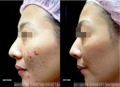 激光去痘疤多少钱 激光如何去痘疤 多少钱