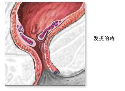 治疗痔疮病有什么办法 治疗痔疮病