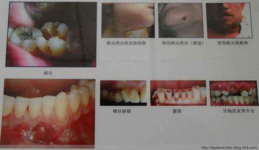 卵巢囊肿的治疗方法 图文：治疗各种“囊肿”的验证方