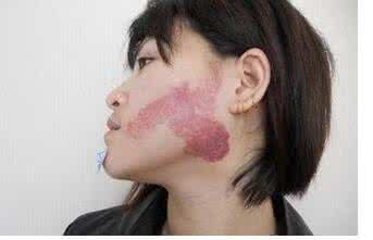 胎记如何去除 胎记去除 如何去除胎记