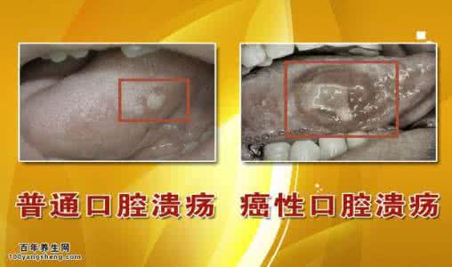 养生堂口腔溃疡视频 20150727养生堂视频和笔记:陈溯,经常口腔溃疡是什么原因,口腔癌