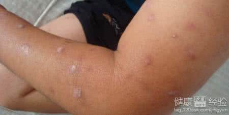 妊娠痒疹治疗方法 妊娠痒疹 妊娠痒疹如何治疗