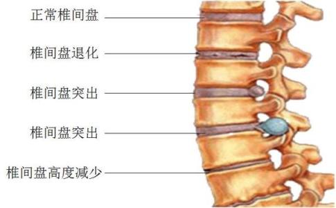 颈腰椎病 颈腰椎病（26图）