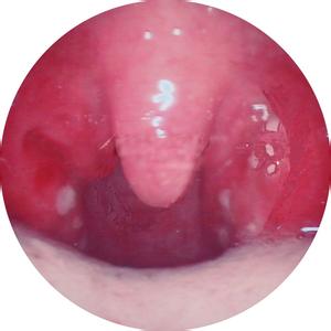 化脓性扁桃体炎治疗 化脓性扁桃体炎治疗 化脓性扁桃体炎注意点