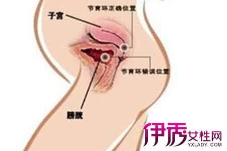 取环后需要卧床休息吗 取环后需要补血吗