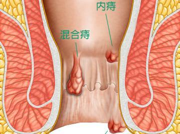 痔疮治疗方法 【痔疮治疗方法大全】