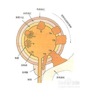 膀胱癌tnm分期 膀胱癌tnm分期 膀胱癌分期