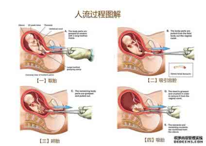 女性做无痛人流的过程 女性的无痛人流是怎么做的呢