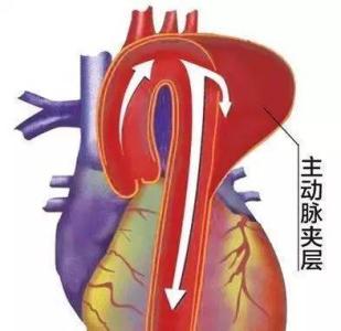 心脑血管药招商 血管里的定时炸弹,3招帮你拆除