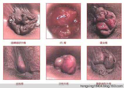 绝招治痔疮 永不复发 【中西治疗】絕招治痔瘡,永不復發!