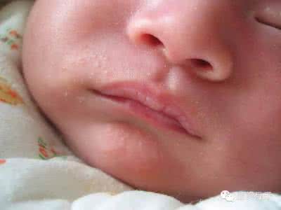 宝宝湿疹怎么护理 宝宝湿疹怎么护理 湿疹宝宝的护理方法宝妈学起来