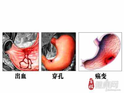 胃穿孔位于胃部哪侧 胃穿孔严重吗 如何保养我们的胃部