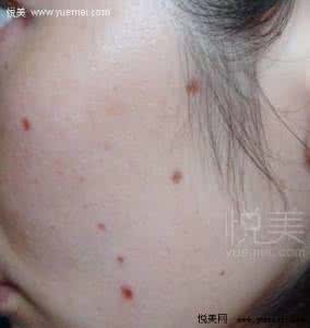 拔牙后可以喝可乐吗 点痣后可以喝可乐的吗