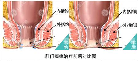 肛门痒是什么原因 肛门痒是什么原因 这就是肛门痒的原因