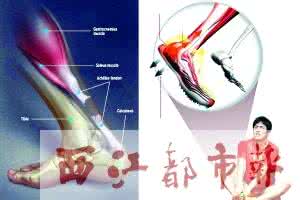 跟腱断裂 跟腱断裂的后果 关键在于急救和治疗