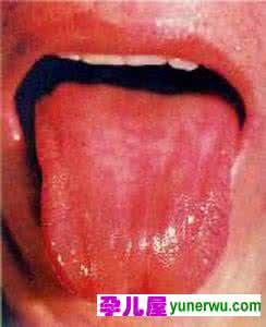 面色无华萎黄偏方 舌像解析|孩子偏瘦、面色萎黄、舌质红,警惕脾阴不足啦!