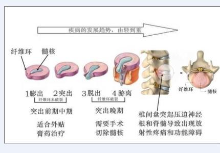 腰椎间盘膨出怎么治疗 腰间盘突出怎么治疗 腰椎间盘膨出怎么治疗