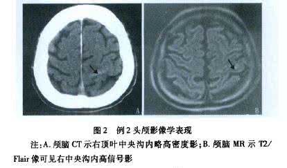 蛛网膜下腔出血2年了 蛛网膜下腔出血2方