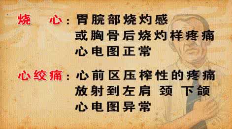 心绞痛科普 科普｜怎么区别“烧心”和“心绞痛”