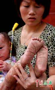 罕见皮肤病 三岁男童患罕见皮肤病 没有幼儿园接收