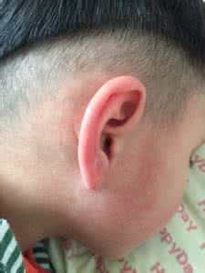 发烧后出疹子注意事项 儿童出疹子发烧怎么办 宝宝发烧后出疹子注意事项