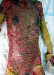 败血症的症状 败血症严重吗 败血症严重吗 败血症的症状