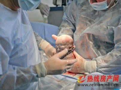 剖腹产视频全部过程 直击：你从没看过的剖腹产全过程