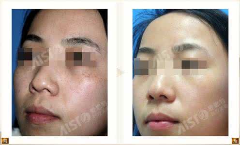 激光去斑有什么副作用 激光去斑有副作用吗 激光祛斑有副作用吗