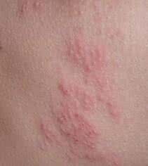 梦见腿上长疮 梦见腿上长疮 梦见腿上生疮