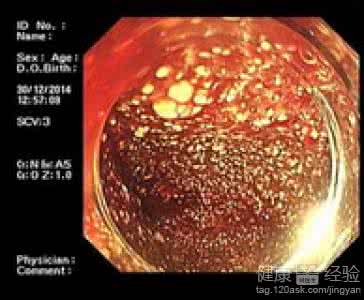 多发性胆囊息肉 多发性胆囊息肉 胆囊息肉9大饮食禁忌