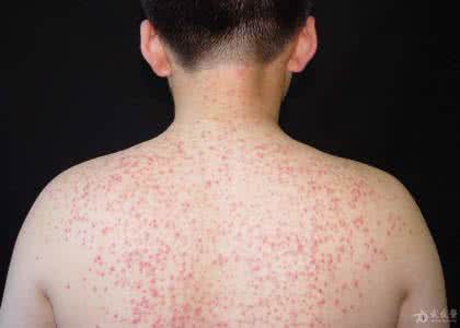 毛囊炎传染吗 毛囊炎传染 正确认识毛囊炎 毛囊炎传染吗?