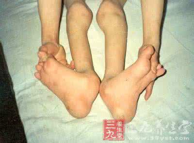 腕管综合征的最佳治疗 刮痧疗法的起源 腕管综合征的刮痧疗法