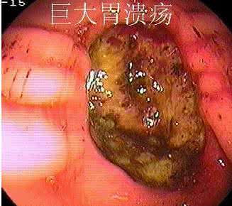 胃溃疡中药治疗最好 用中药治疗重症胃溃疡一例