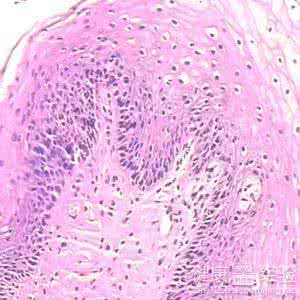宫颈炎的症状用什么药 宫颈尖锐湿疣用什么药 宫颈口尖锐湿疣的症状