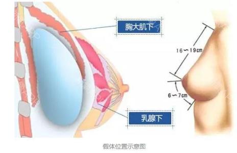 假体隆胸后影响哺乳吗 假体隆胸影响哺乳吗 假体隆胸会对哺乳有影响吗