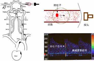 经颅多普勒 经颅彩色多普勒超声诊断脑动脉狭窄及闭塞的准确性分析