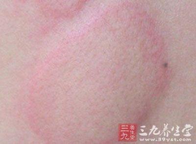 荨麻疹饮食禁忌 荨麻疹禁忌 小细节远离烦人的荨麻疹