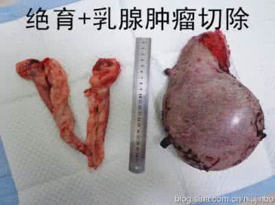 乳腺恶性肿瘤症状 乳腺恶性肿瘤 乳腺恶性肿瘤的常见症状