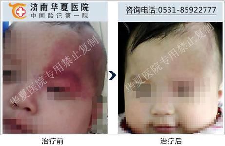婴儿胎记形成的原因 婴儿胎记是怎么形成的 婴儿胎记形成的原因是什么