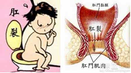 肛裂了怎么办 肛裂又犯了怎么办?