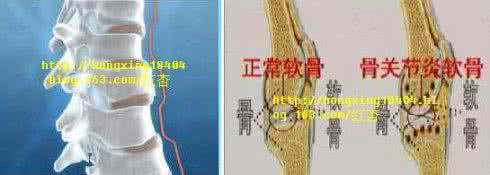 农村治疗骨质增生偏方 治骨质增生症秘方（方9首）