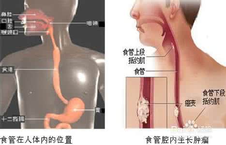 治疗食道癌的特效药 食道癌的早期症状 食道癌特效药