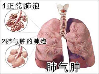 治疗肺气肿的民间偏方 【民间偏方】治肺气肿有根治效果